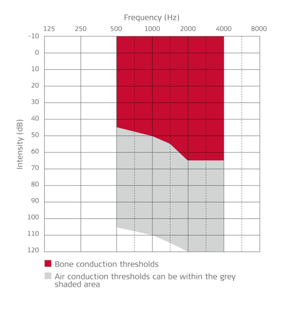 Conductive or mixed hearing loss