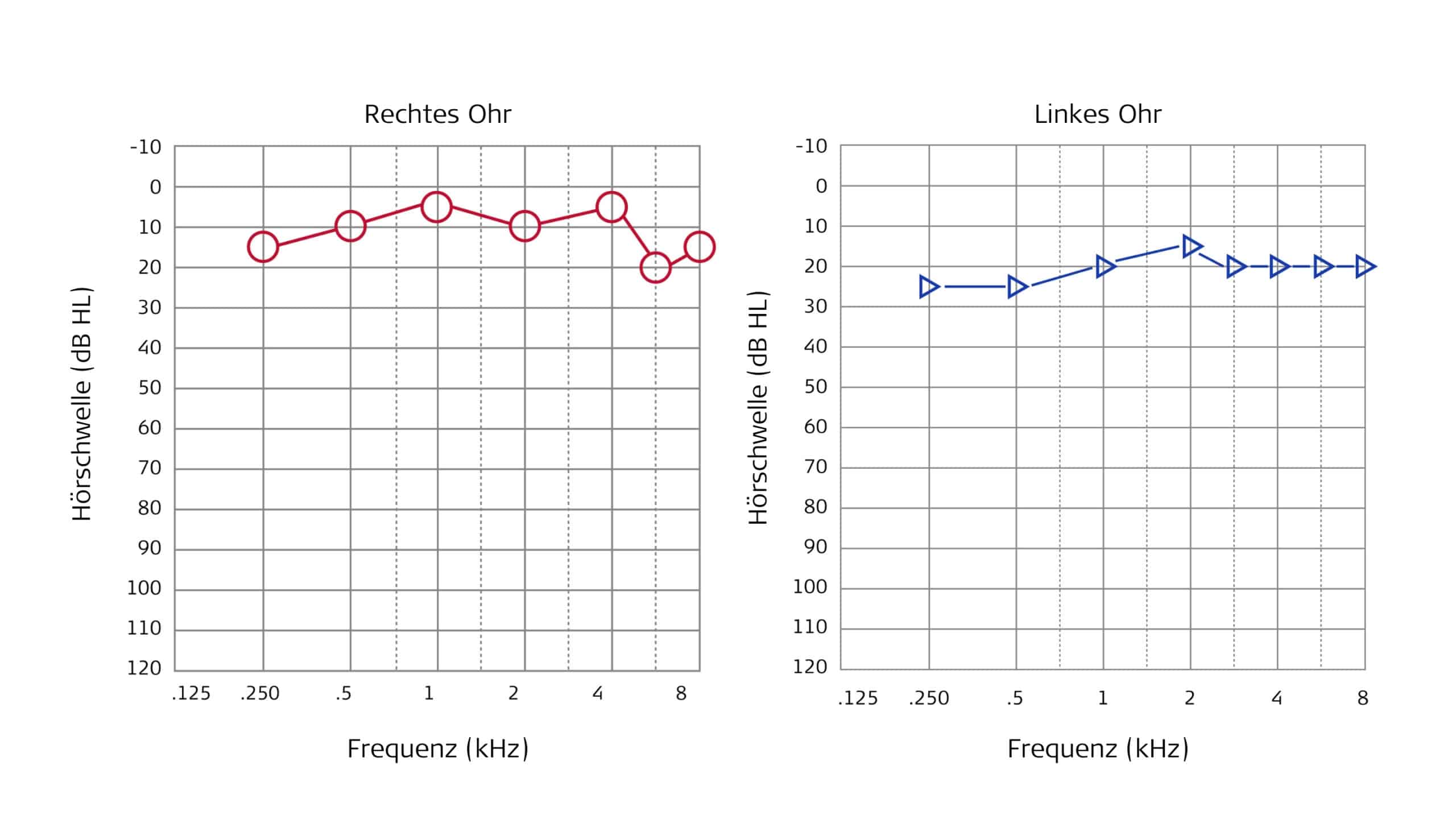 Patientenfall, Audiogramm