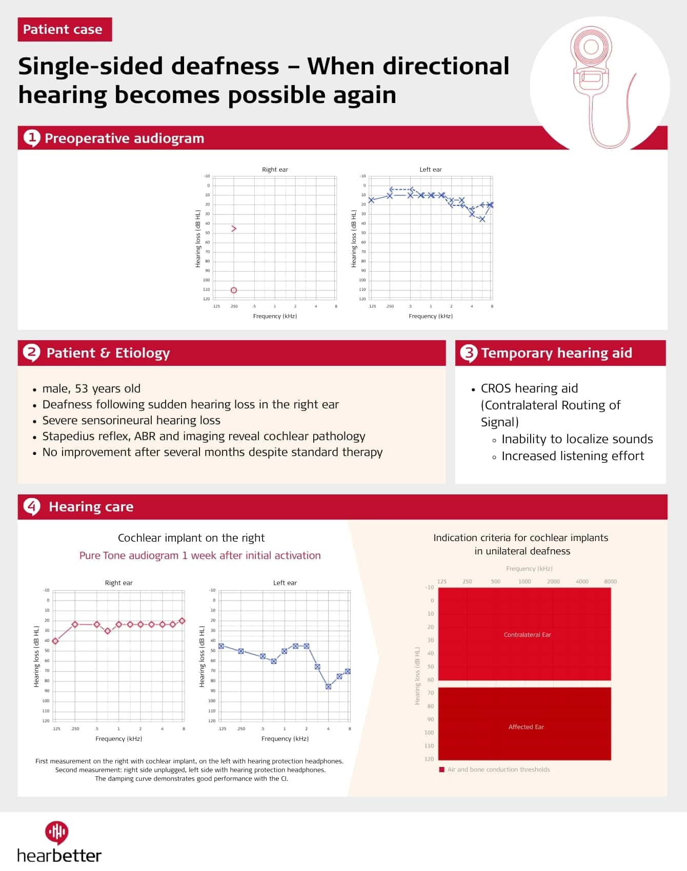 Audiogram SSD after sudden hearing loss