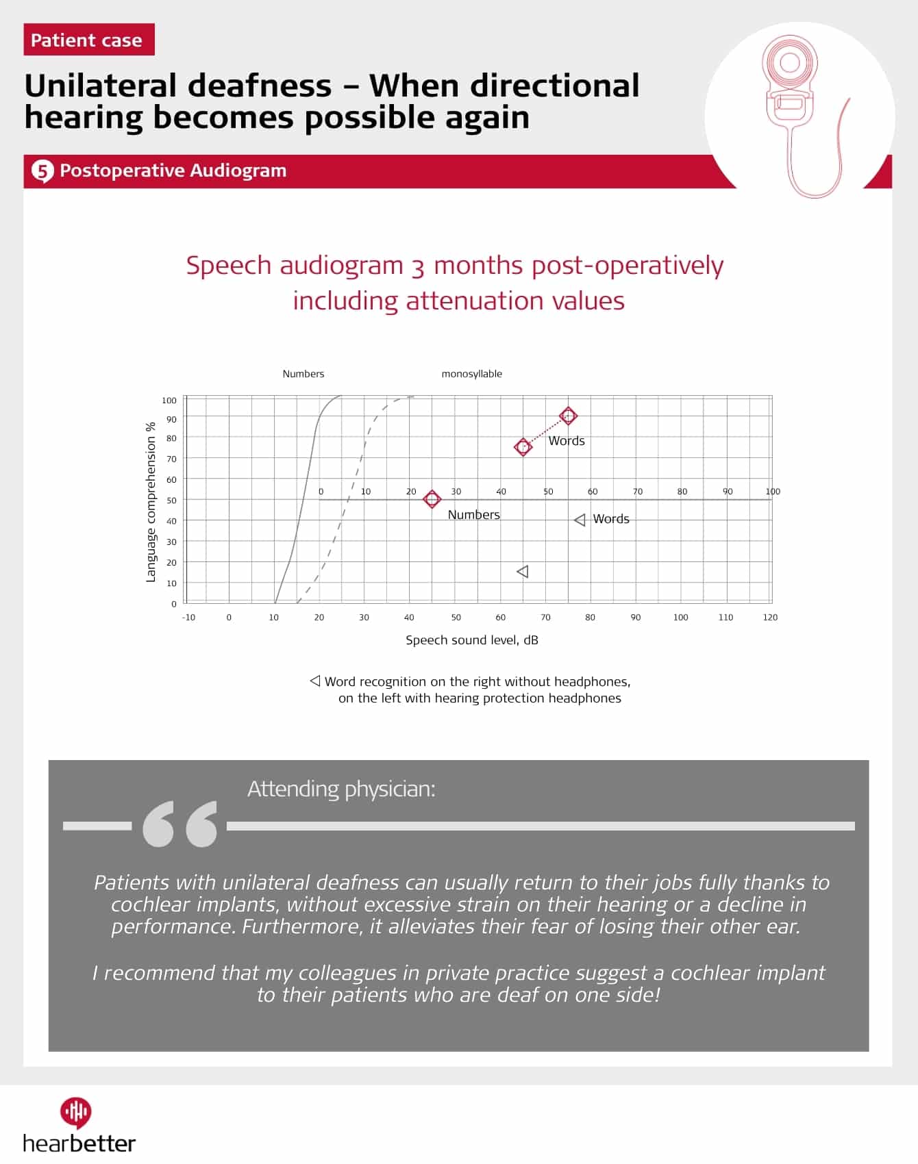 Audiogram SSD after sudden hearing loss