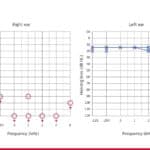 Audiogram - Single-sided deafness following meningitis