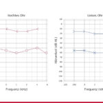 Patientenfall: Audiogramm - Bilateraler konduktiver Hör- verlust durch Cholesteatom