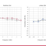 Audiogramm: Kleinkind mit komplexen Malformationen